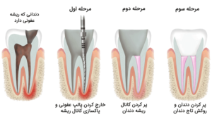 درمان ریشه یا عصب کشی